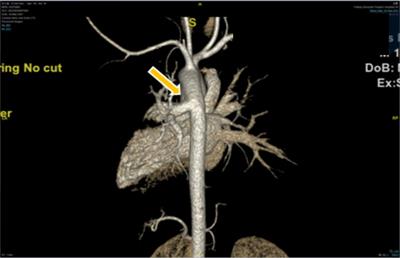 Anesthesia management in a patient with anomalous origin of left pulmonary artery from the descending aorta: A case report and literature review